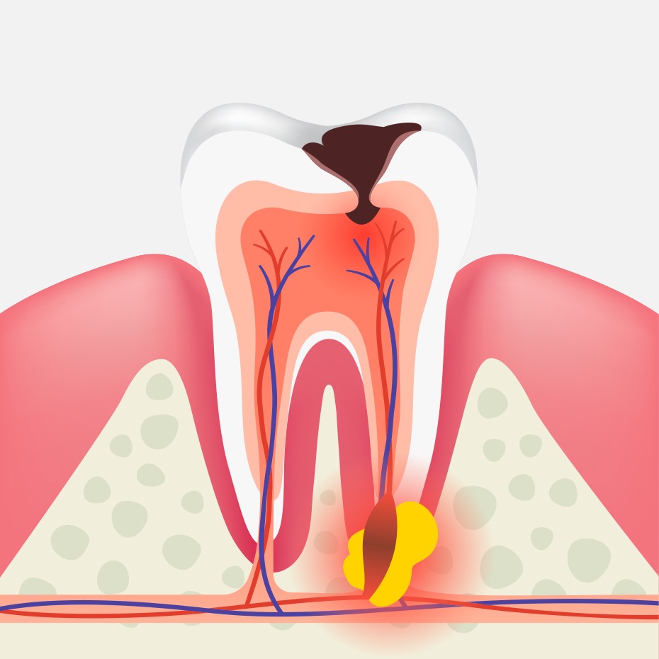 Abcesso Periapical