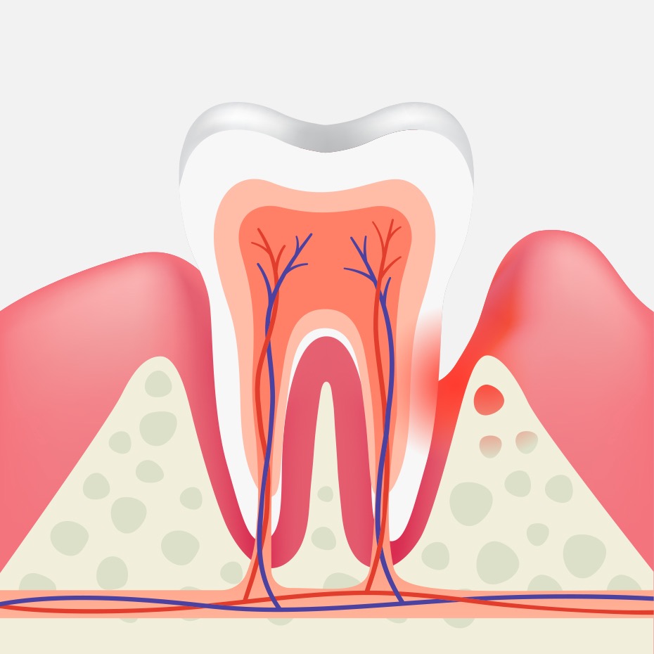 Abcesso Periodontal